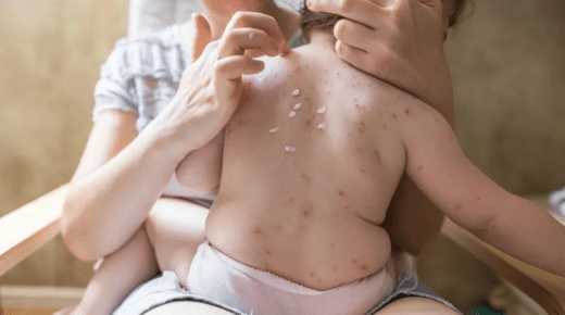 Understanding the Difference Between Measles and Chickenpox