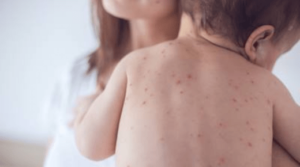 Unveiling the Differences - Chickenpox and Measles