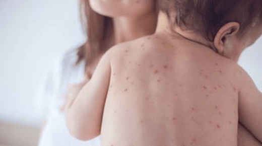 Unveiling the Differences - Chickenpox and Measles