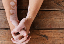 best vitiligo treatment in Coimbatore