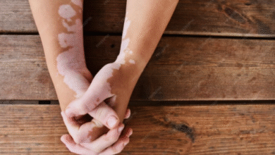 best vitiligo treatment in Coimbatore
