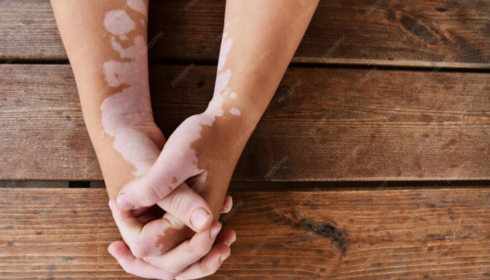 best vitiligo treatment in Coimbatore